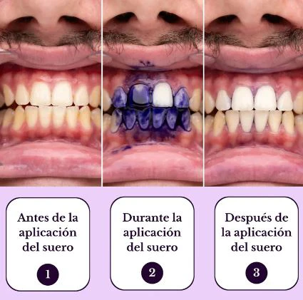 Sonrisa Radiante en 15 Segundos - Espuma Blanqueadora V34